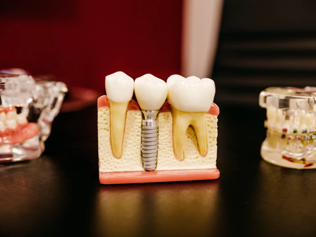 Exploring the cost of dental implants in Atlanta at All On Implants Atlanta
