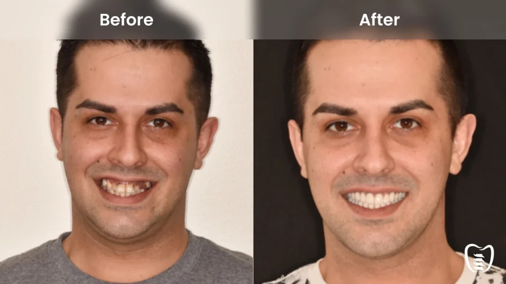 Before and after dental implants at All On Implants Atlanta