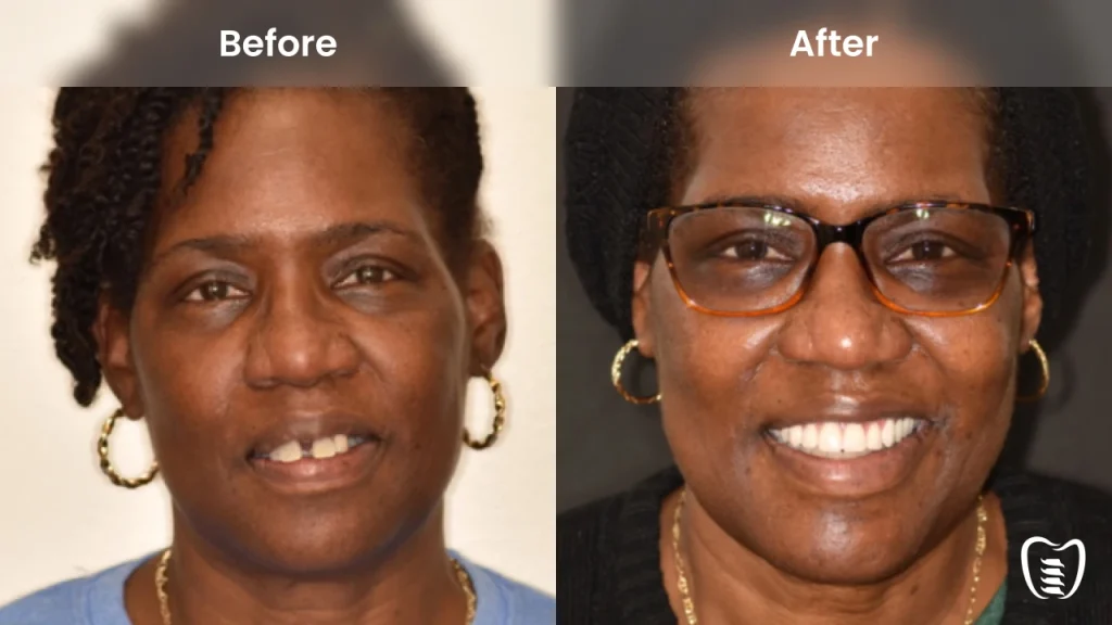 Before and after dental implants at All On Implants Atlanta