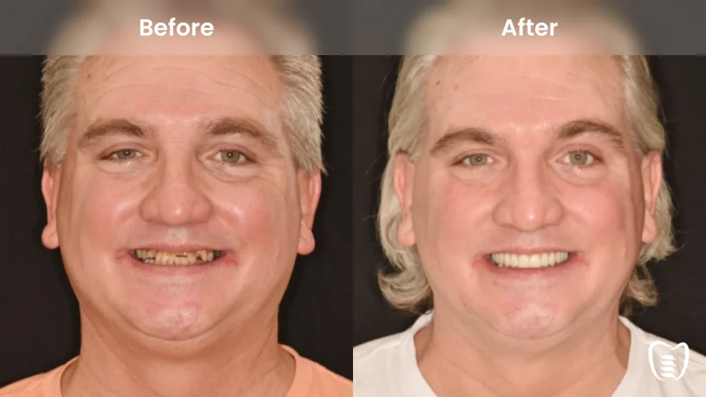 Before and after dental implants at All On Implants Atlanta