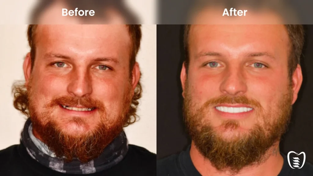 Before and after dental implants at All On Implants Atlanta