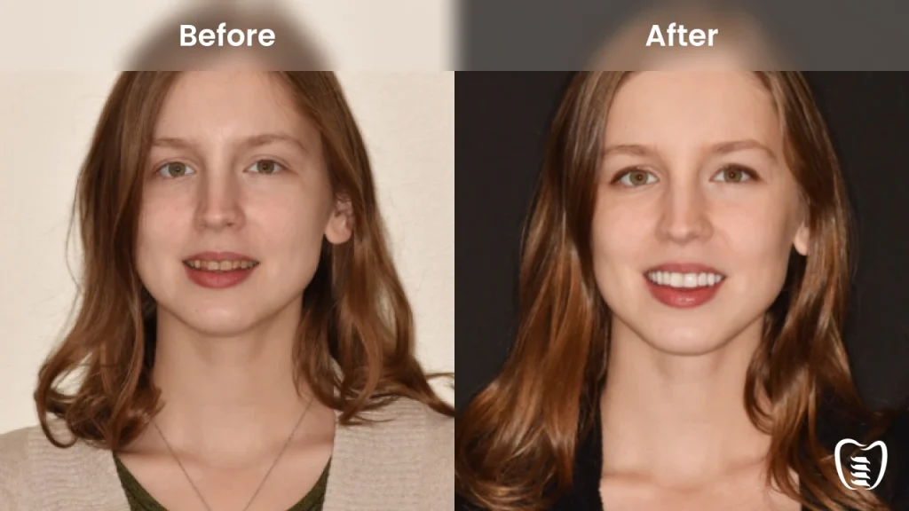 Before and after dental implants at All On Implants Atlanta