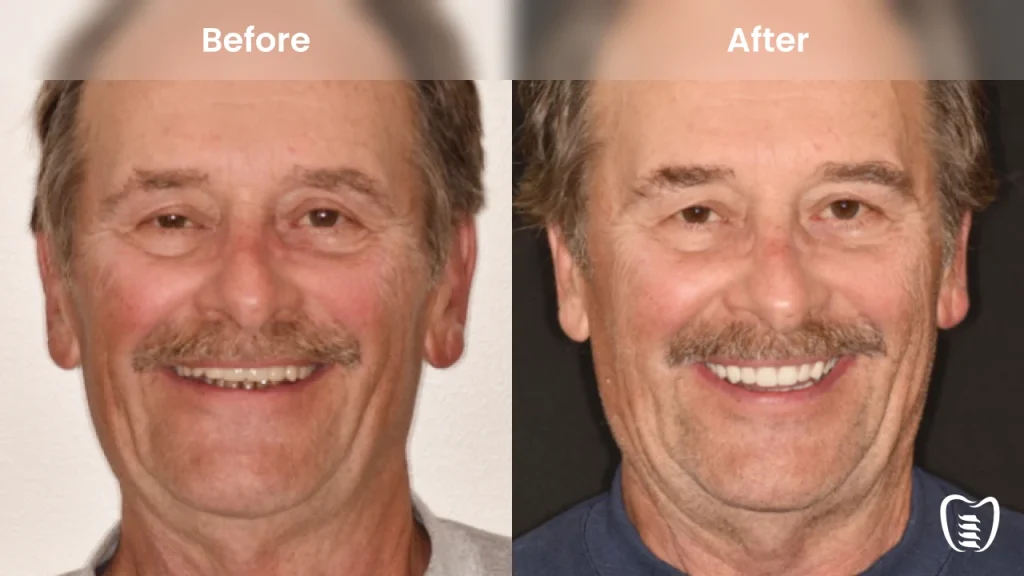 Before and after dental implants at All On Implants Atlanta