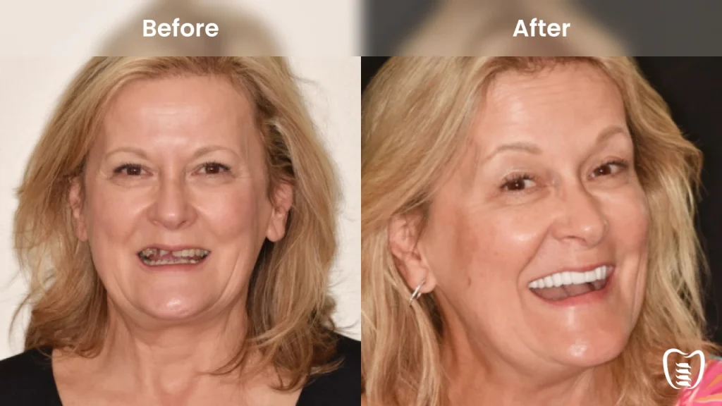 Before and after dental implants at All On Implants Atlanta