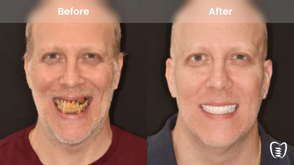 Before and after dental implants at All On Implants Atlanta