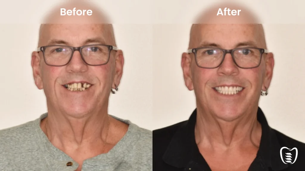 Before and after dental implants at All On Implants Atlanta