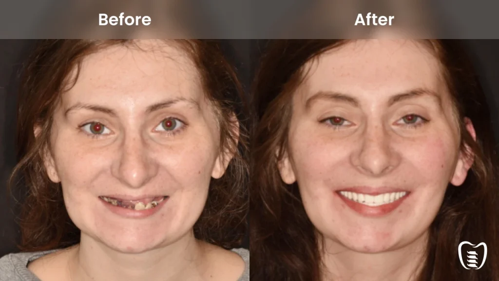 Before and after dental implants at All On Implants Atlanta