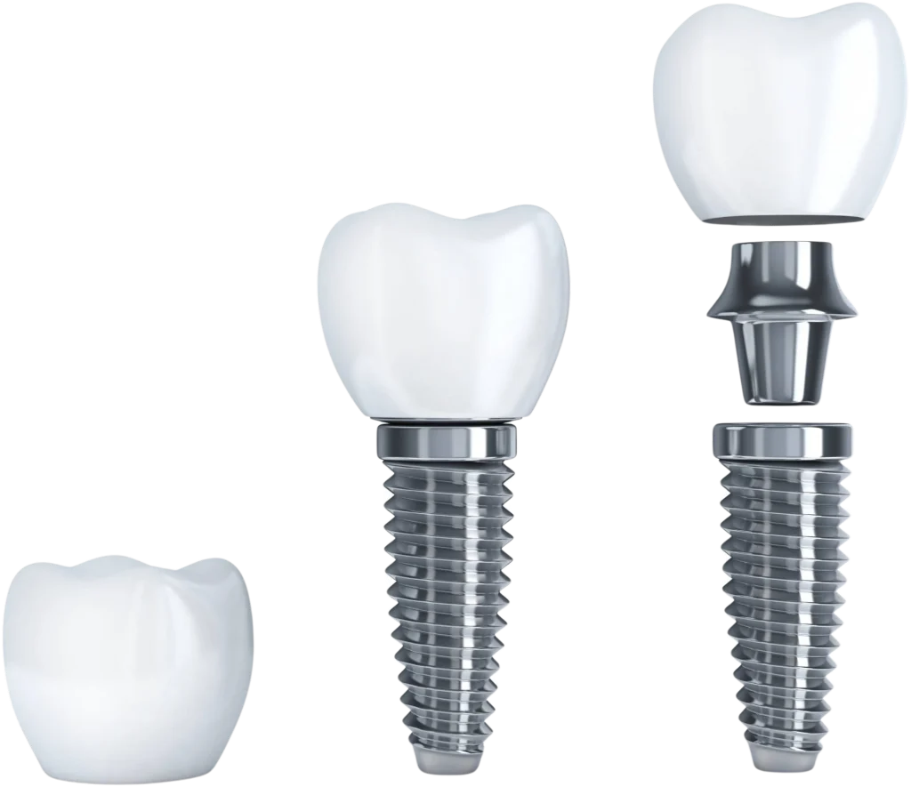 Single tooth dental implant model showing the implant body, abutment, and tooth crown